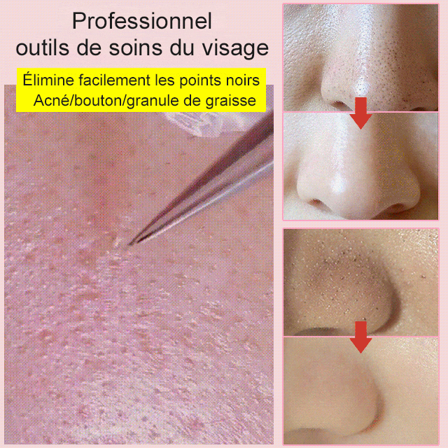 pinzas para eliminar la espinilla del acné✨Tu experto personal en el cuidado de la piel