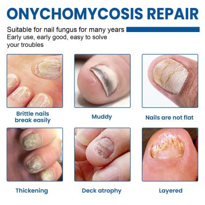 Fungus Nail Repair Patches 60pcs Ximonth®