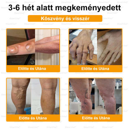 𝑺𝒕𝒂𝒘𝑽𝒊𝒕𝒂𝒍® Botoxot és Méhmérget Tartalmazó Regeneráló Krém Ízületekre és Csontokra | Ortopédiai problémák és ízületi fájdalmak célzott kezelésére🔥