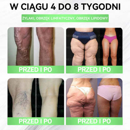 🌱 💞Oficjalny Sklep | 👩‍⚕️🎁 𝐏𝐙𝐆𝐎𝐍𝐄® Superfood 𝑵𝒂𝒏𝒐 Mikronakłuwana Plaster 🇵🇱(Tylko raz dziennie, widoczne zmiany już w 7 dni)✅ Na otyłość, 🅛🅞🅞🅢🅔 🅢🅚🅘🅝 wiotką skórę, cukrzycę, bezdech senny, problemy ze stawami i wiele więcej