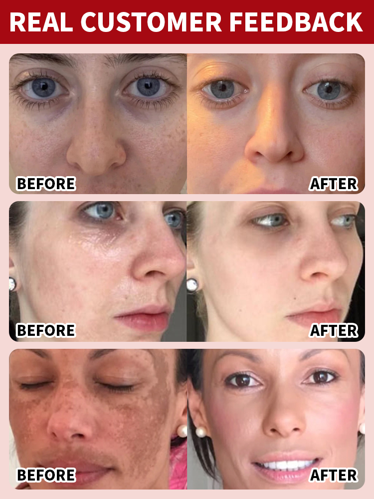 【3 in 1】Whitening, Anti-Blemish and Anti-Wrinkle Essence【See visible results in just 5 days!】【💯We Promise: If Ineffective, We Offer a 10x Refund!💯】