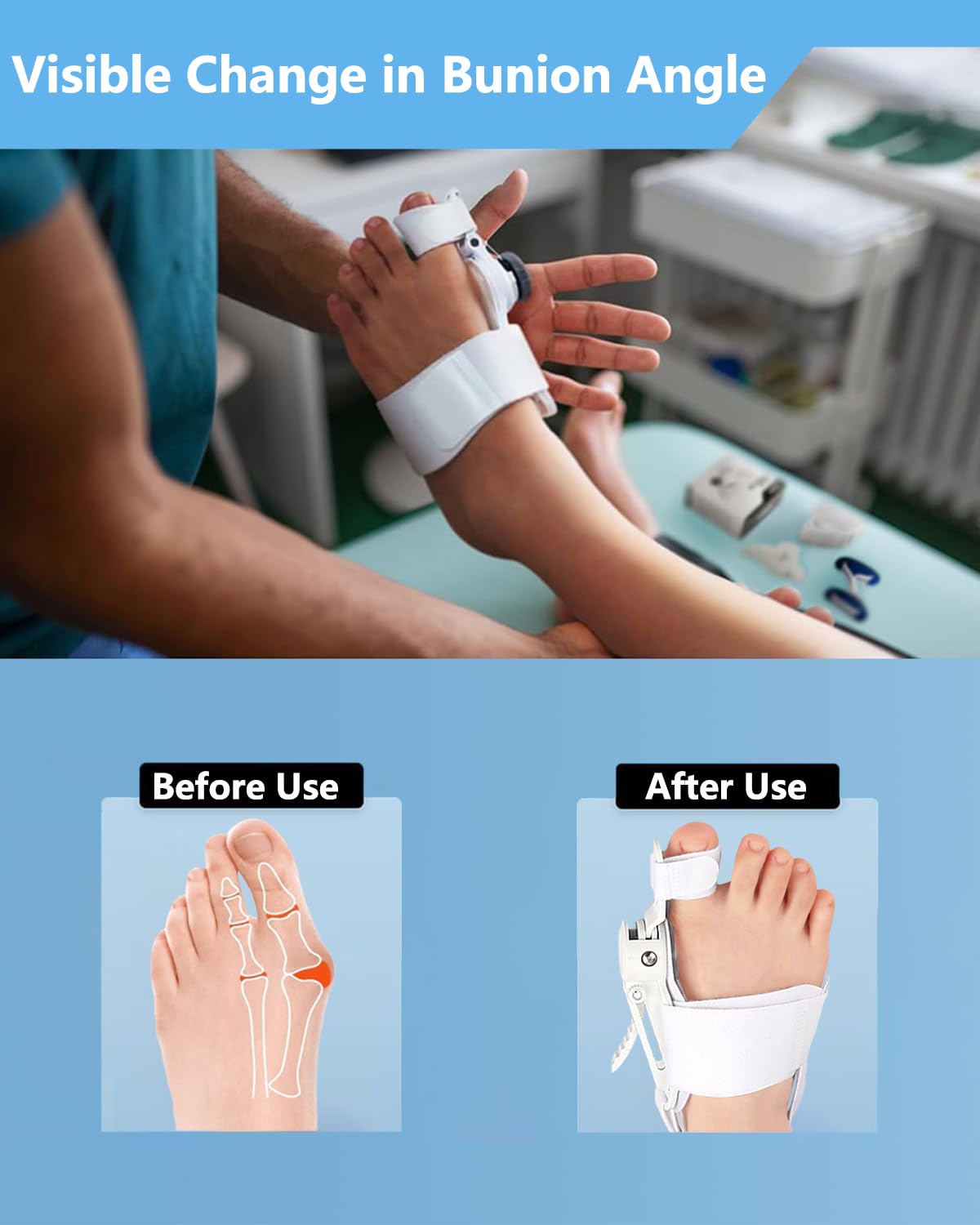 Hallux Valgus Corrector – Toe Separator & Bunion Aligner for Effective Foot Relief and Support