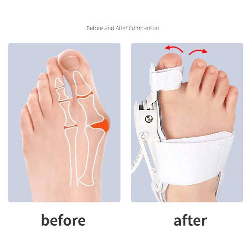 Hallux Valgus Corrector – Toe Separator & Bunion Aligner for Effective Foot Relief and Support