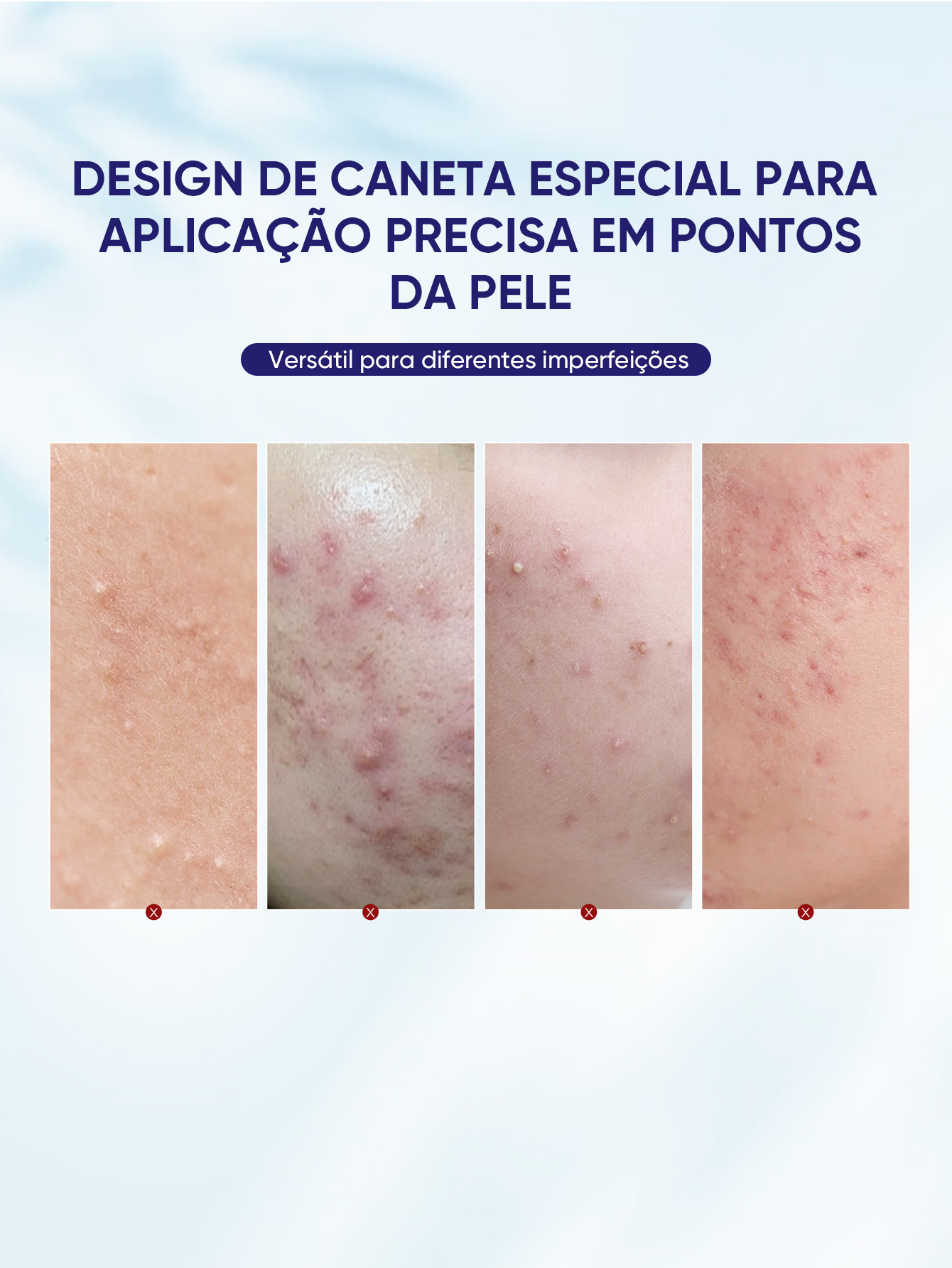 QUARXERY Acne Spot Saviour: Solução 3 em 1 para Acne – Melhora Visível em Poucos Dias + Fortalece Barreira Cutânea