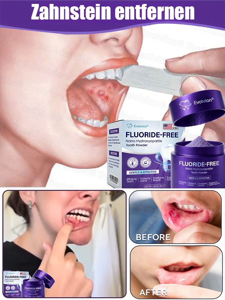 ✅Zahnverfärbungen lösen, Karies vorbeugen, Zahnfleisch reparieren - 50% Rabatt