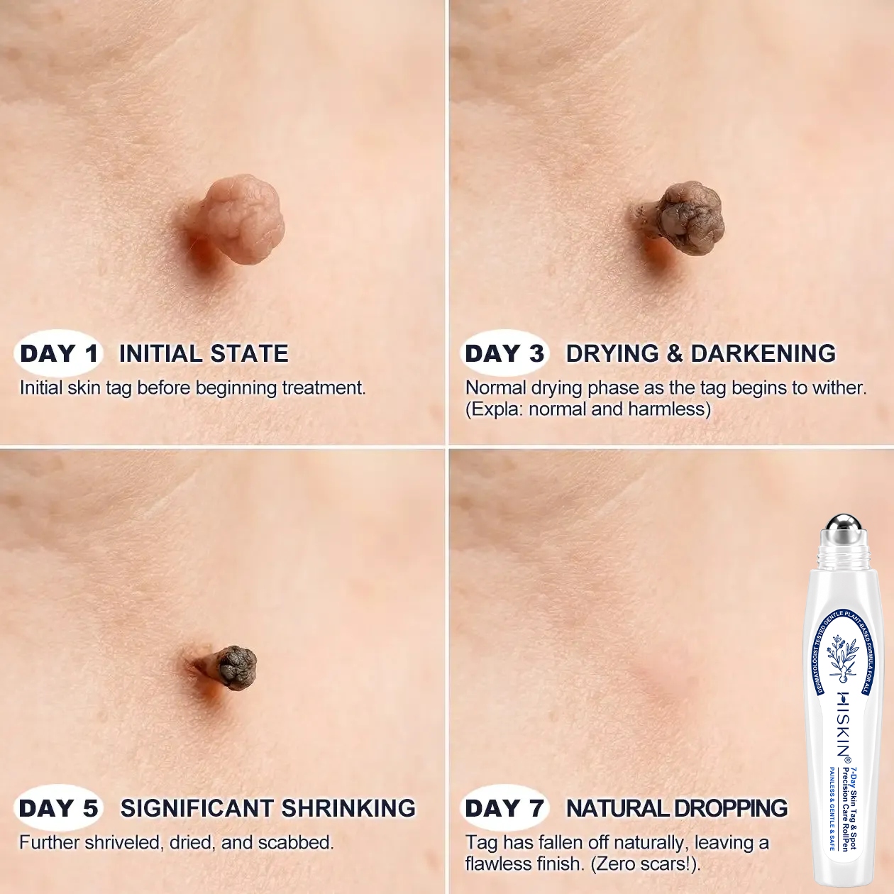 👩‍⚕️ 𝟕-𝐃𝒂𝘆 𝐒𝗸𝐢𝐧 𝐓𝒂𝗴 & 𝐒𝐩𝙤𝐭 𝐄𝐫𝒂𝐬𝙚𝐫 Painless & Scar-Free Advanced Imperfection Removal Rollerball Pen