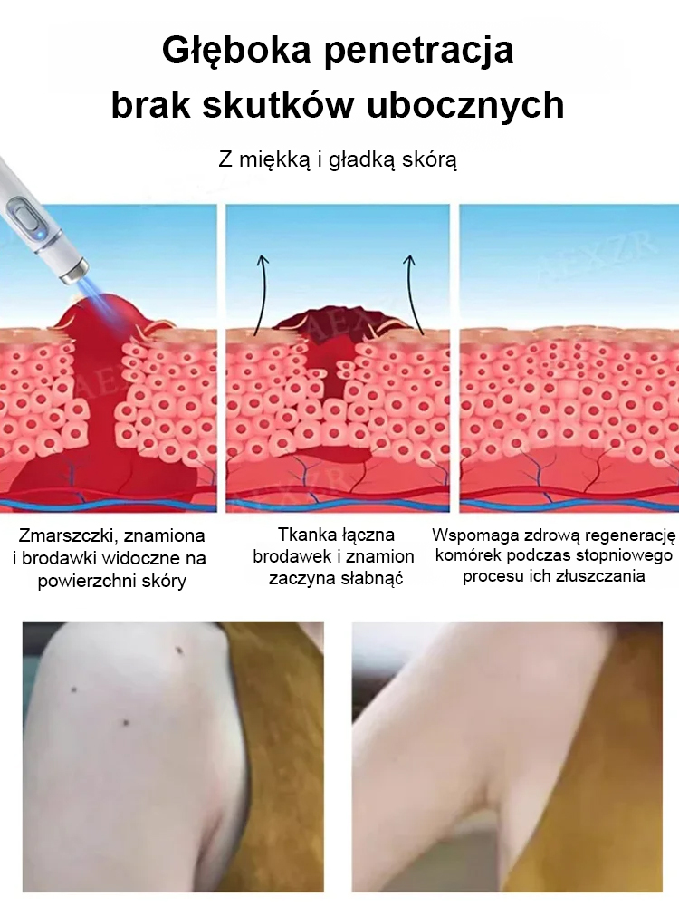 Laserowe bezbolesne pióro do usuwania brodawek