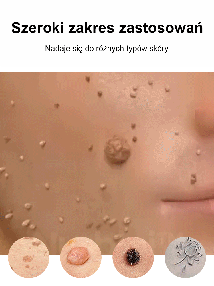 Laserowe bezbolesne pióro do usuwania brodawek