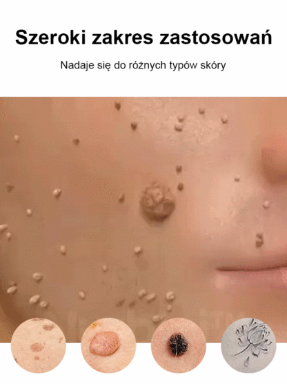 Laserowe bezbolesne pióro do usuwania brodawek