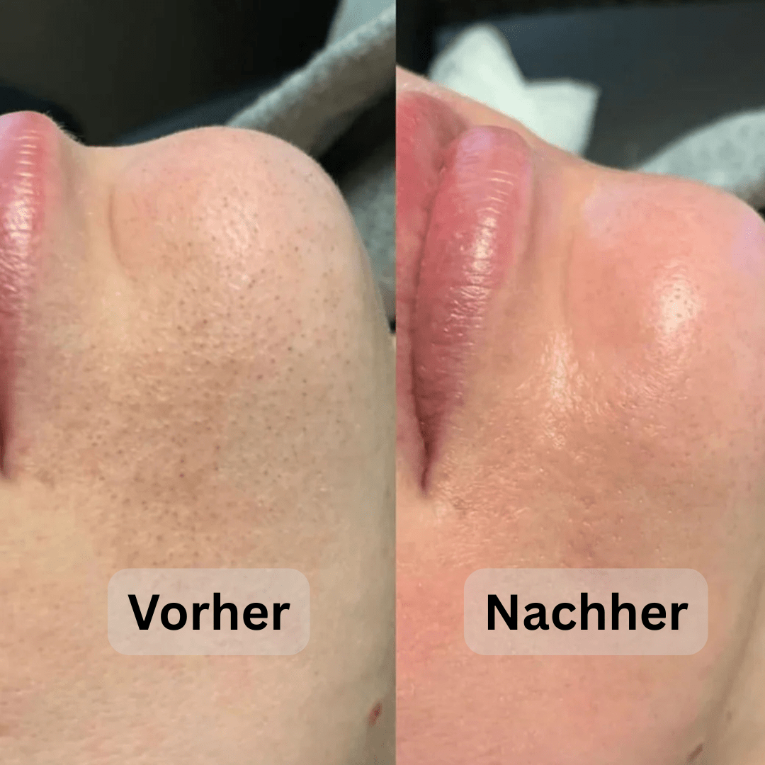 Reis Peeling-Hellasbeauty