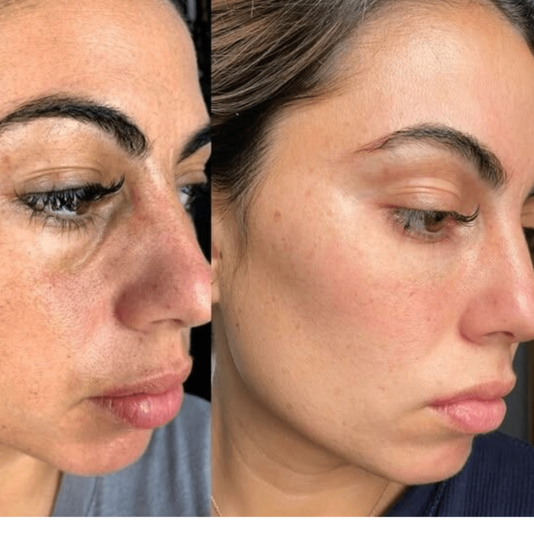 Reis Peeling-Hellasbeauty