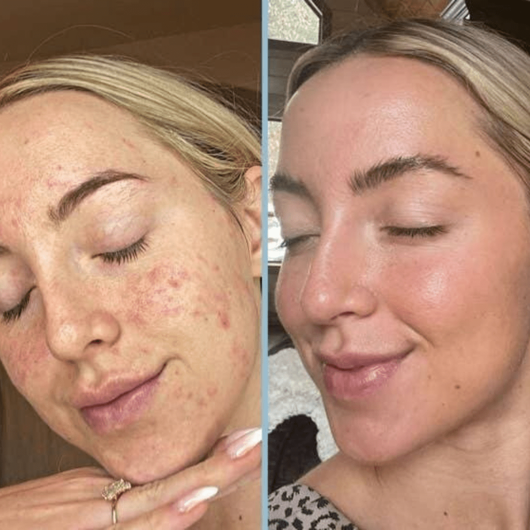 Reis Peeling-Hellasbeauty