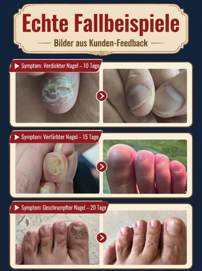 【Nagelpflegelösung 】Dringt tief in die Nägel ein und bekämpft Nagelpilz an der Wurzel.