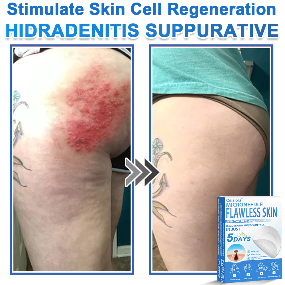 🏆2-in-1 Microneedle & Hydrocolloid Patch | Raised Moles,Acne,  Flat Warts & Skin Tags Remover | Improves Wrinkles, Scars & Blemishes | Invisible Pimple Patches for Face & Body