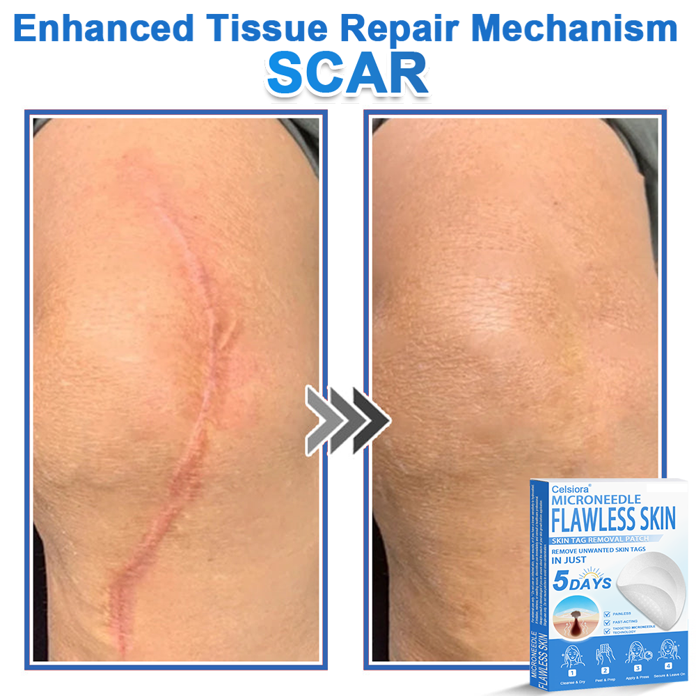 🏆2-in-1 Microneedle & Hydrocolloid Patch | Raised Moles,Acne,  Flat Warts & Skin Tags Remover | Improves Wrinkles, Scars & Blemishes | Invisible Pimple Patches for Face & Body