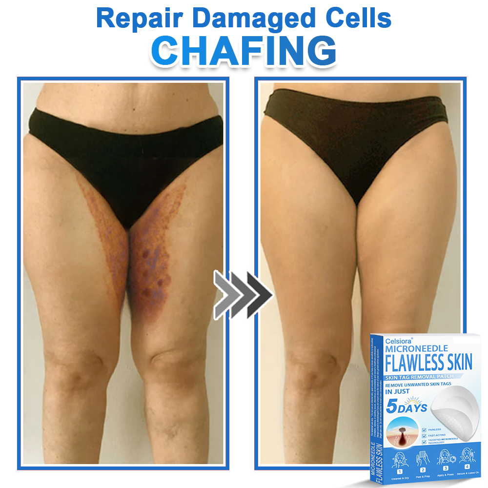 🏆2-in-1 Microneedle & Hydrocolloid Patch | Raised Moles,Acne,  Flat Warts & Skin Tags Remover | Improves Wrinkles, Scars & Blemishes | Invisible Pimple Patches for Face & Body