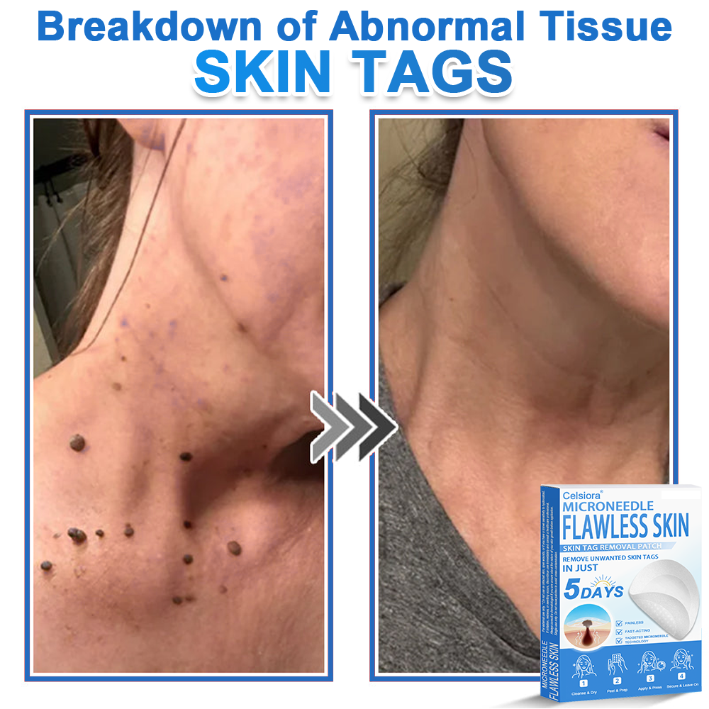 🏆2-in-1 Microneedle & Hydrocolloid Patch | Raised Moles,Acne,  Flat Warts & Skin Tags Remover | Improves Wrinkles, Scars & Blemishes | Invisible Pimple Patches for Face & Body