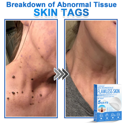 🏆2-in-1 Microneedle & Hydrocolloid Patch | Raised Moles,Acne,  Flat Warts & Skin Tags Remover | Improves Wrinkles, Scars & Blemishes | Invisible Pimple Patches for Face & Body