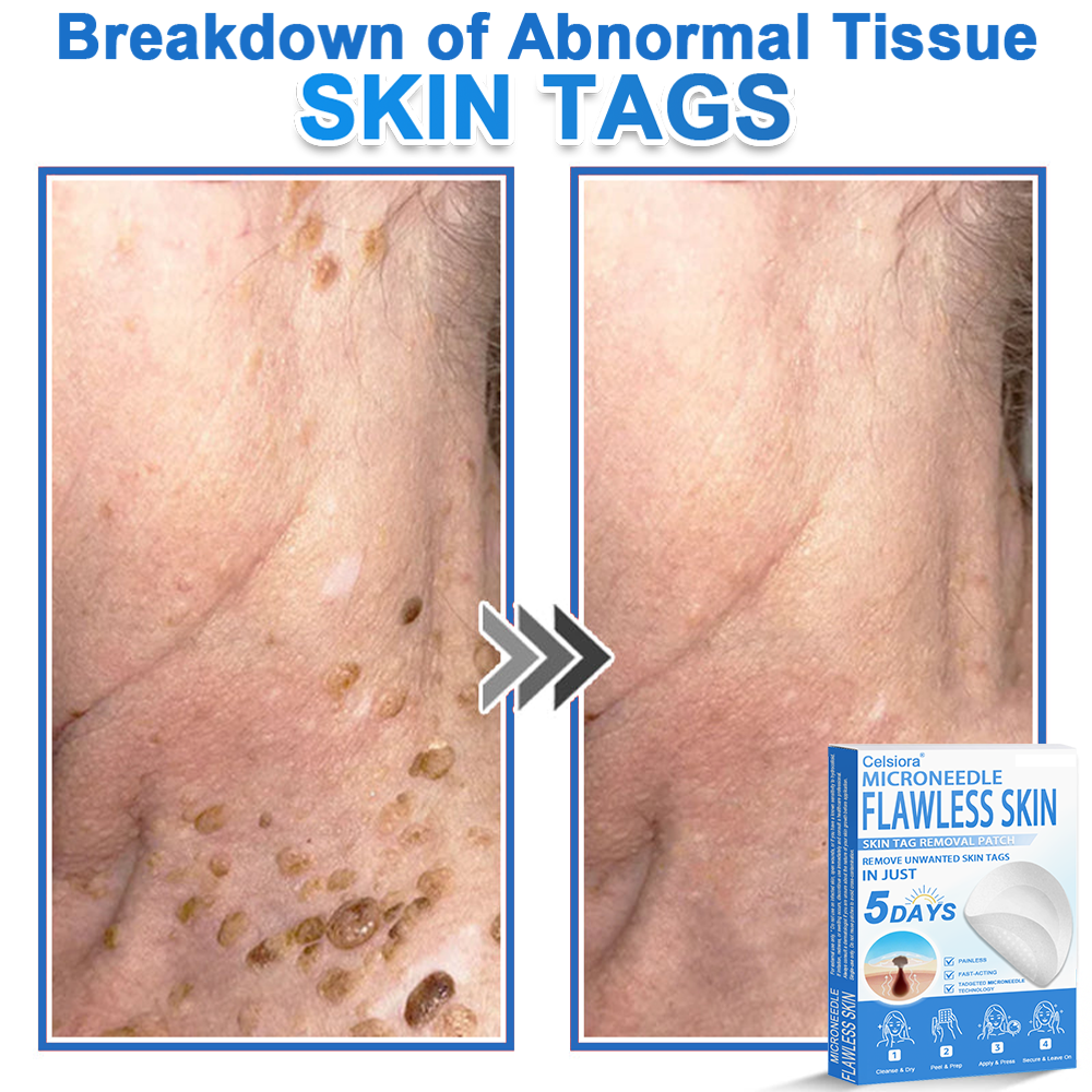 🏆2-in-1 Microneedle & Hydrocolloid Patch | Raised Moles,Acne,  Flat Warts & Skin Tags Remover | Improves Wrinkles, Scars & Blemishes | Invisible Pimple Patches for Face & Body