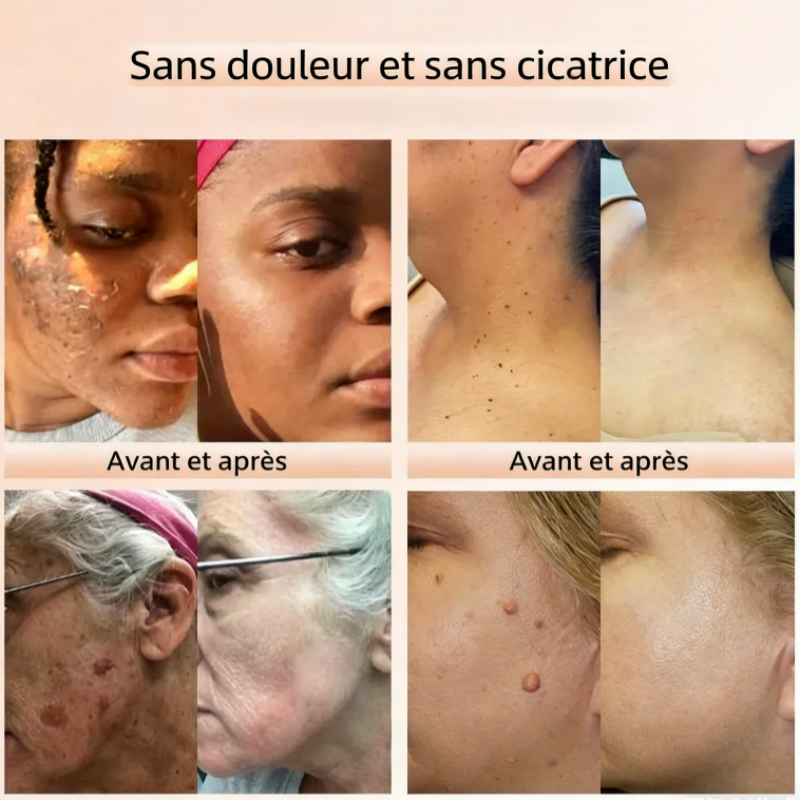 Tag Recede™ Traitement Verrues et Papillomes au Venin d’Abeille + Acide Salicylique