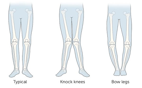 I bambini piccoli hanno le ginocchia valghe e le gambe arcuate
