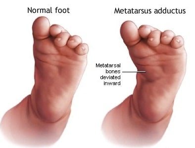 Metatarso addotto del piede del bambino che gira verso l'interno Piedi girati verso l'interno nel metatarso addotto del bambino