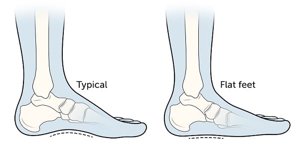 Anatomia del piede piatto e dell'arco plantare normale