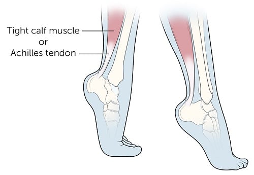Muscoli macchiati che camminano in punta di piedi nel bambino
