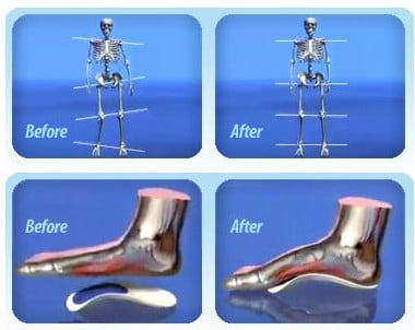 Postura supportata da ortesi per bambini