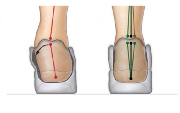 Caviglie deboli e pronazione nel bambino