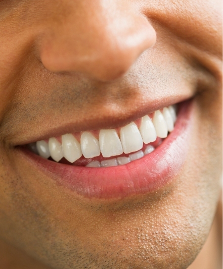 【Hordozható fogsor tokot tartalmaz】 Fogsorok, amelyek visszaadják mosolyát