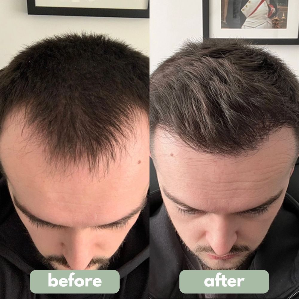 Unrosebody - Hair Growth Serum