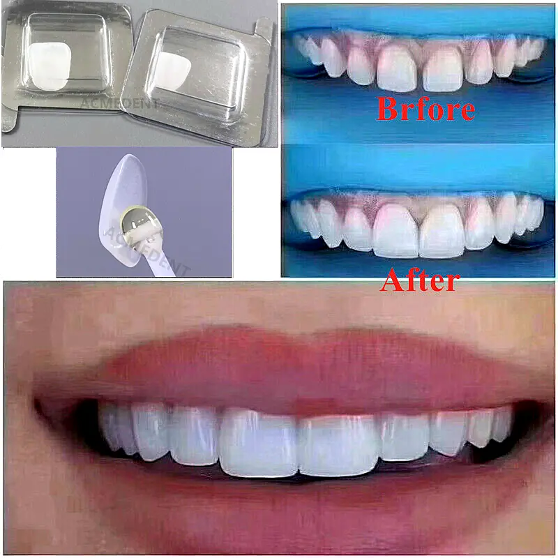 Dental Composite Porcelain Veneers Teeth Whitening Resin Crown Veneer