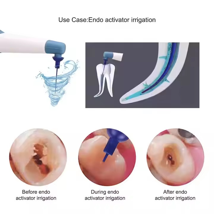 Dental Endodontics Ultra Activator Handpiece | Root Canal Irrigation Sonic Activator Kit with 60Pcs Tips