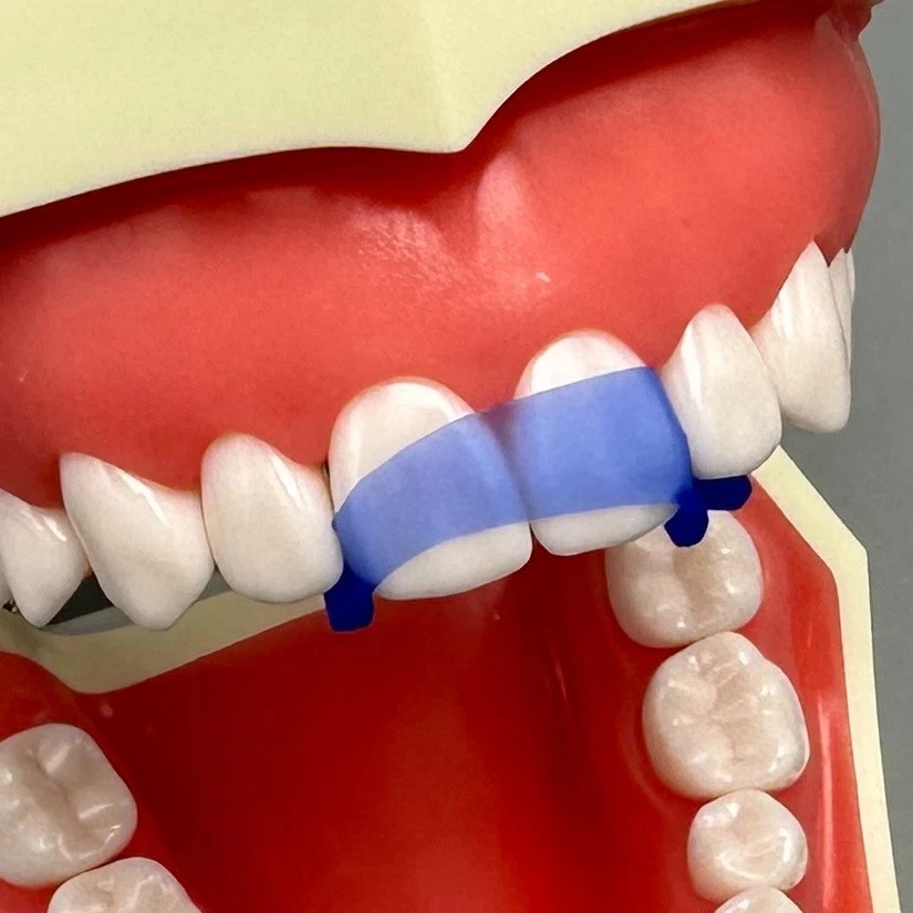 10Pcs Dental Elastic Wedges Protector All-in-one Front Anterior Teeth Matrices Wedge