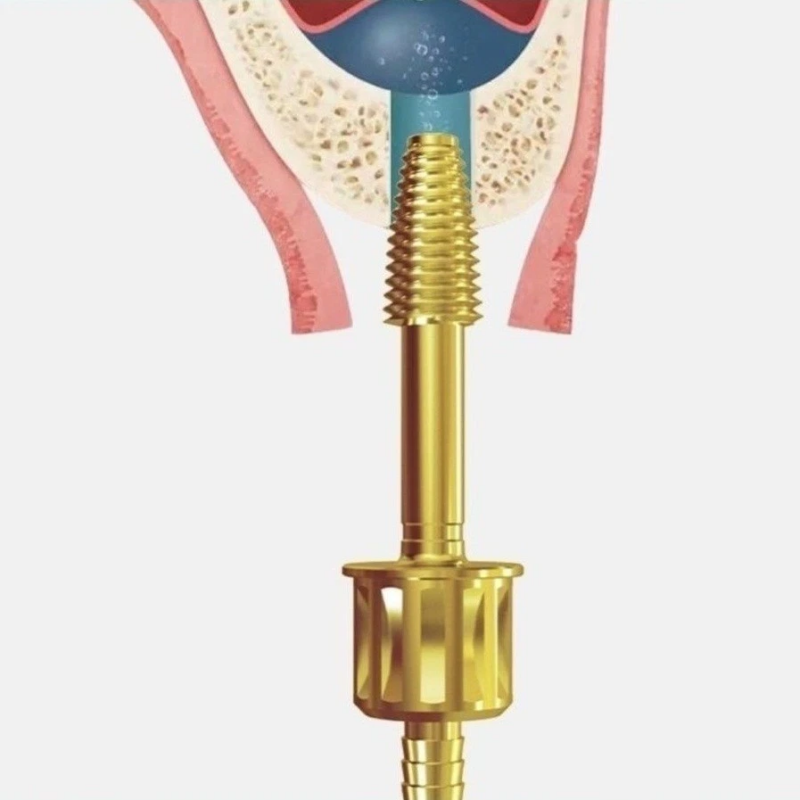Dental Hydraulic Water Tip with Gold Threaded Connector – Leak-Proof Irrigation Head for Dental Unit Systems