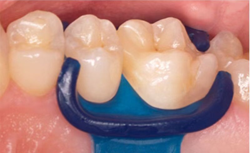 Silicone Dental Mini Rubber Dam Wedge  Isolation Suitable for Adults and Children 5pcs