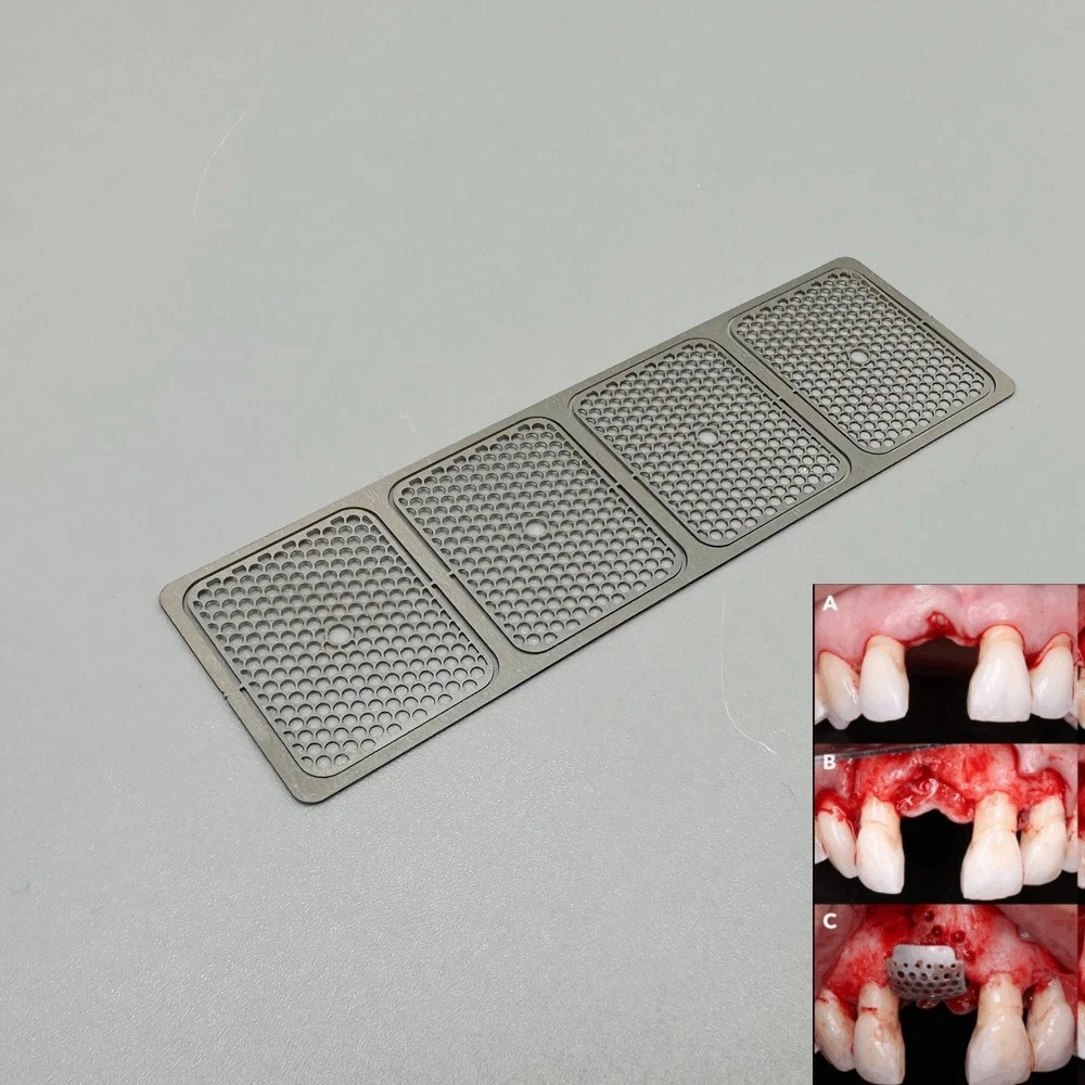 Dental Titanium Mesh Membrane Implant Sidewall GBR Safety Fixture Mesh Plates