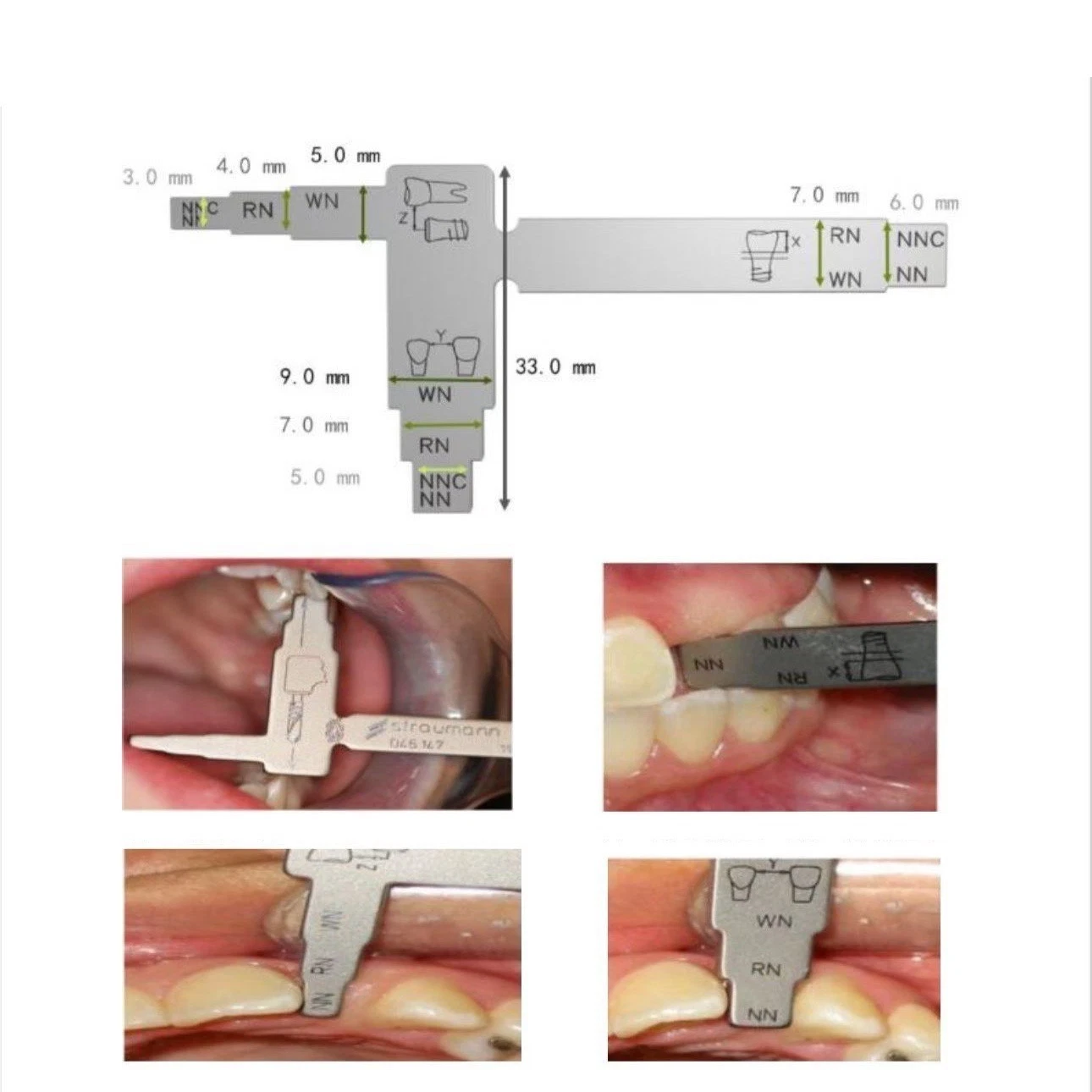 Dental T-shape Implant Measure Ruler Locating Caliper Distance Guide Ruler