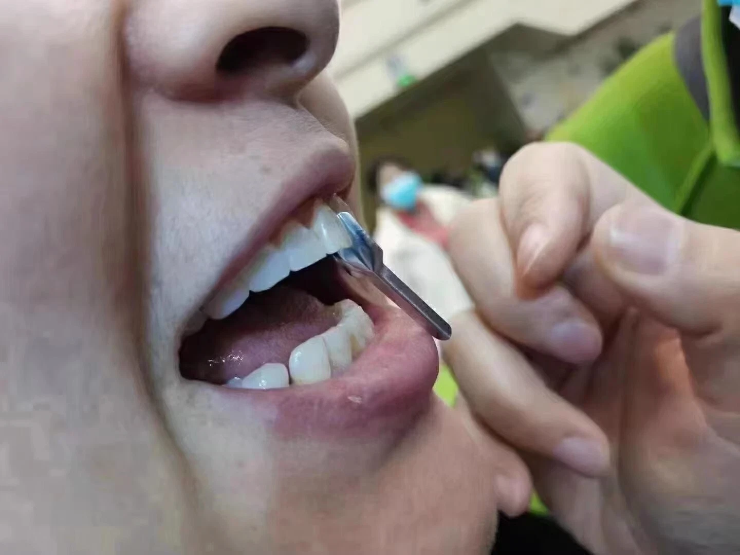 Dental Matrix Bands Twin Anterior Proximal Strips Sectional Contoured Matrices