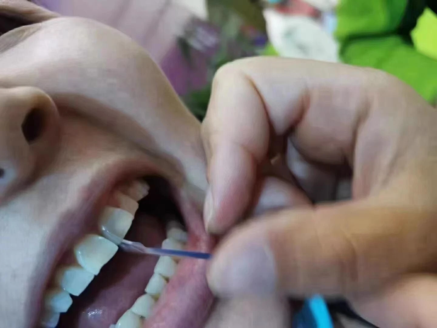 Dental Matrix Bands Twin Anterior Proximal Strips Sectional Contoured Matrices