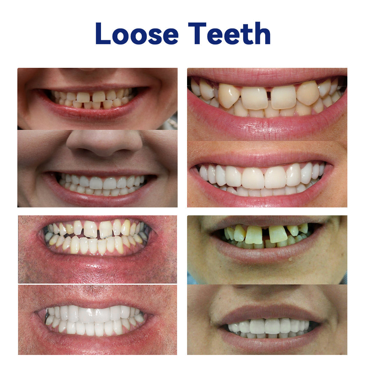 HAIMUZIL™ 🦷Комплект силиконови линийки за протези (съвместими с ADA и одобрени от зъболекари)