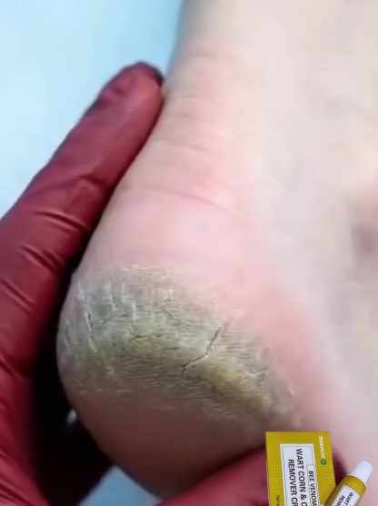 Bee-derived active ingredients Calluses Removal Cream