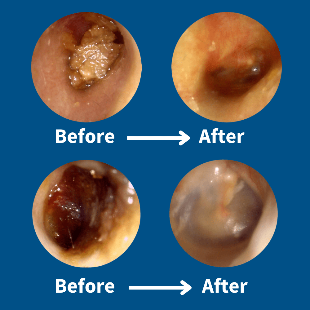 ClearEar™ Earwax Removal Kit