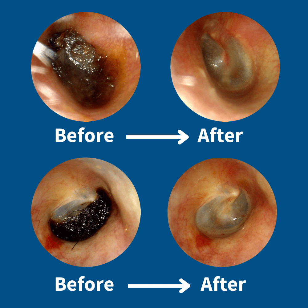 ClearEar™ Earwax Removal Kit