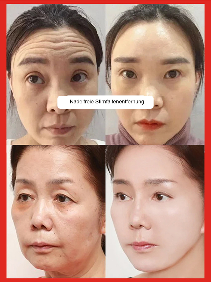 【1+1 GRATIS】Lachs-Hyaluron-Serum | Sofort-Effekt gegen Falten | Strahlend jung in jedem Alter