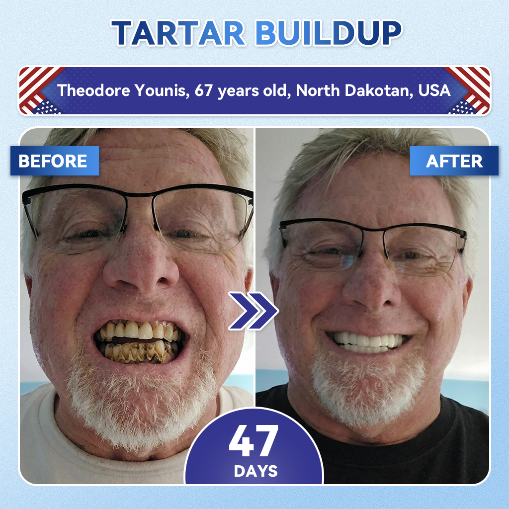 ⏳LAST DAY SALE 49% OFF!🔥Your Smile~ SmileFitPro® 🦷 Tideglusib Fast‑Dissolving Tooth & Gum Repair Oral Strips ✨