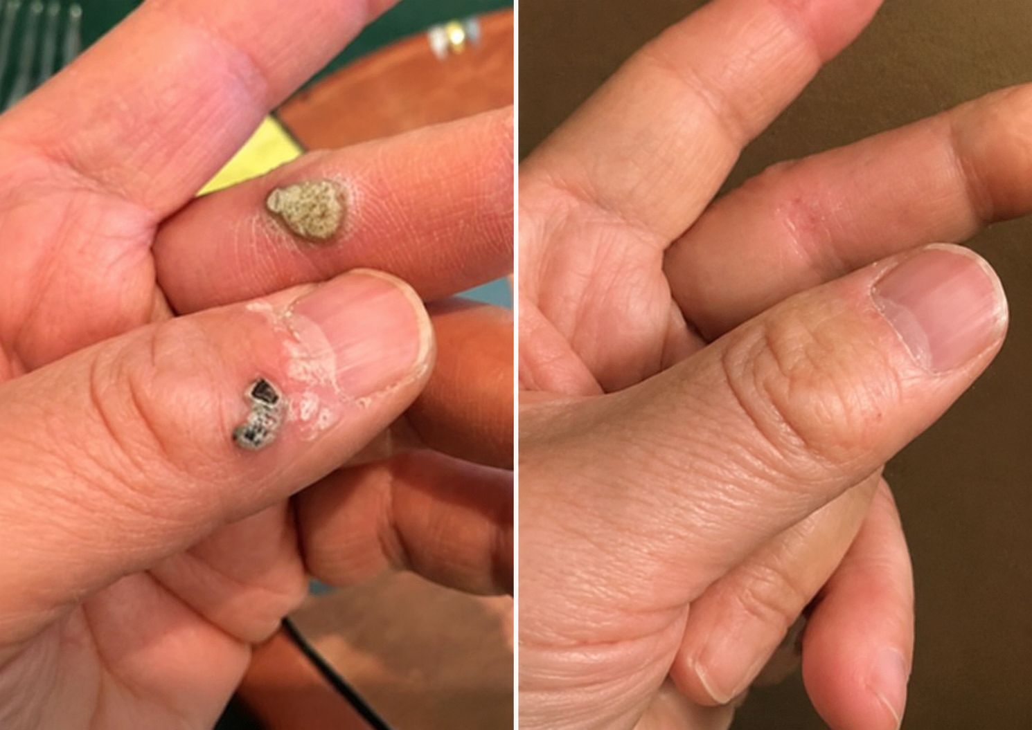 2-in-1 Microneedle & Hydrocolloid Patch🍀| Removes Raised Moles, Acne, Flat Warts & Skin Tags | Helps Improve Wrinkles, Scars & Blemishes | Invisible Patches for Face & Body