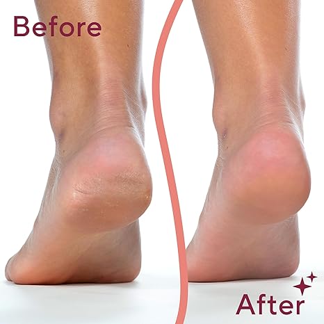 Electric foot file: Easily removes calluses and dead skin from feet.