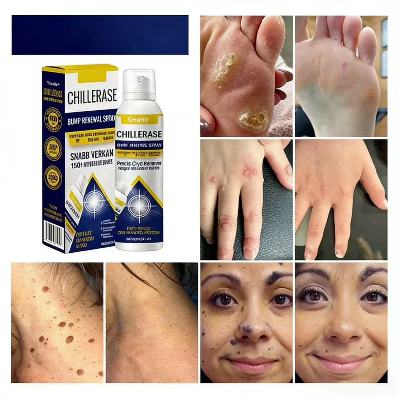 ChillErase förnyande spray för magen ⏰50 % rabatt under en begränsad tid – köp 3, få 2 🔥